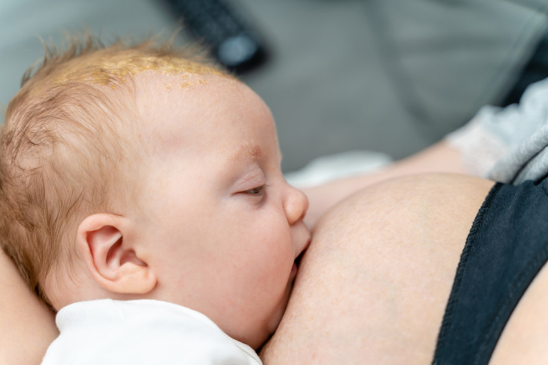 困倦新生兒頭部皮膚問題搖籃帽脂溢性皮炎母乳喂養特寫圖片素材