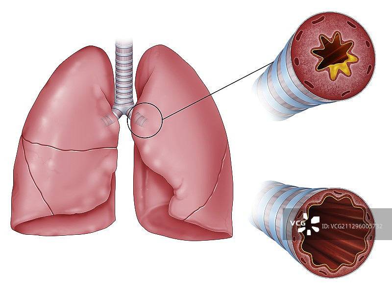肺气道炎症，对比插图图片素材