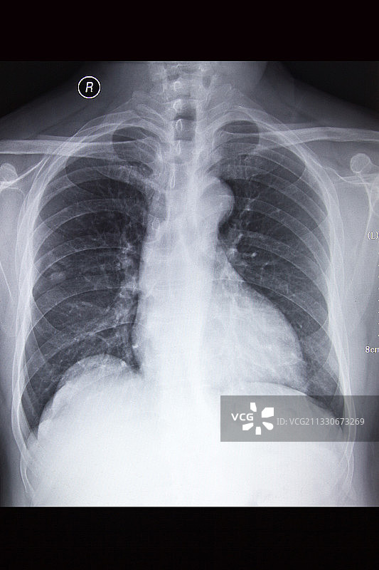 医学DR摄影X射线胶片影像图图片素材