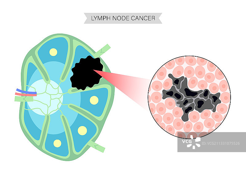 淋巴瘤癌症的概念图片素材