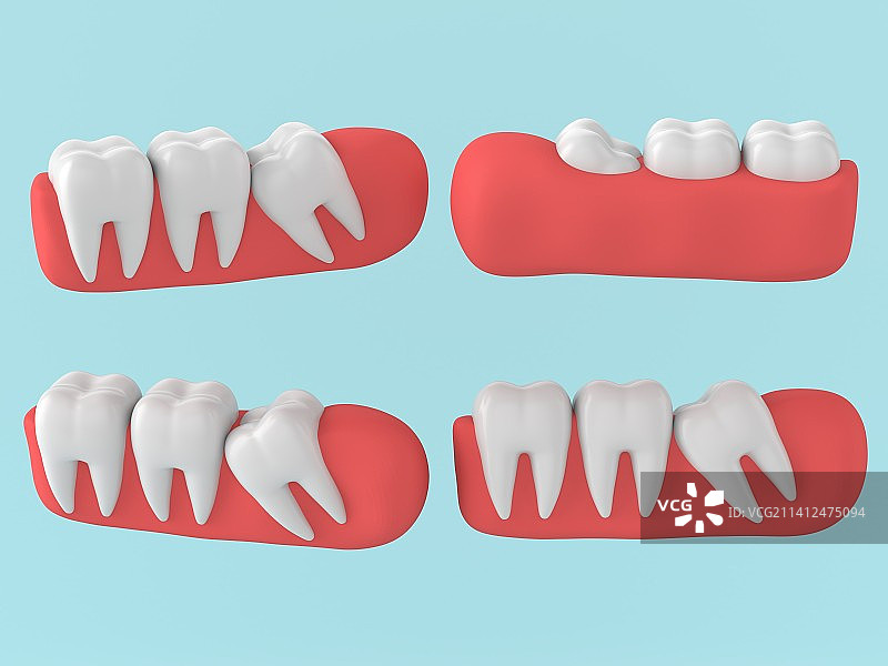 立体3d上排牙齿牙龈模型图片素材
