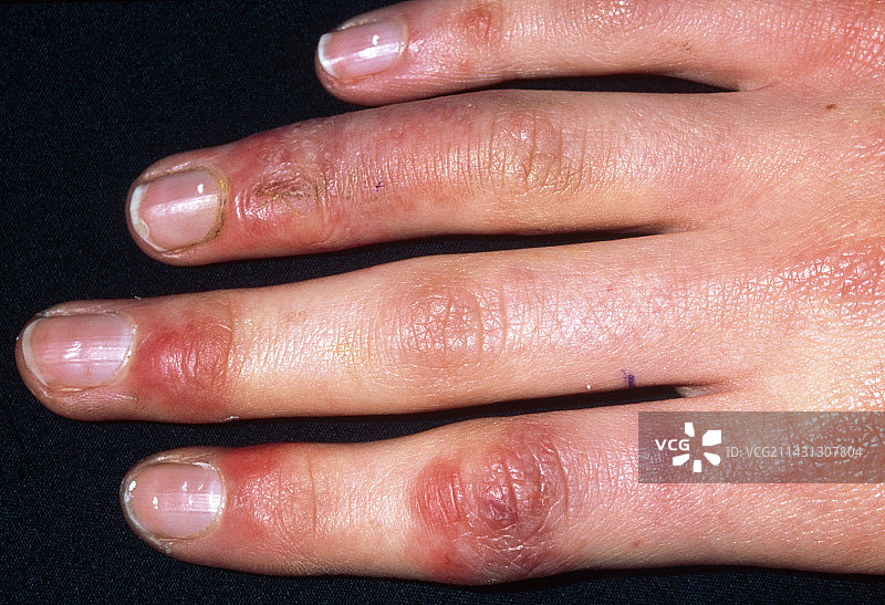 一个16岁女孩手指上的冻疮图片素材