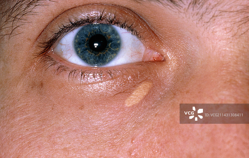 下眼睑黄斑瘤沉积图片素材