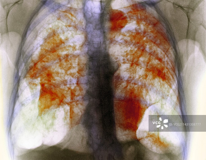 肺矽肺，x线检查图片素材