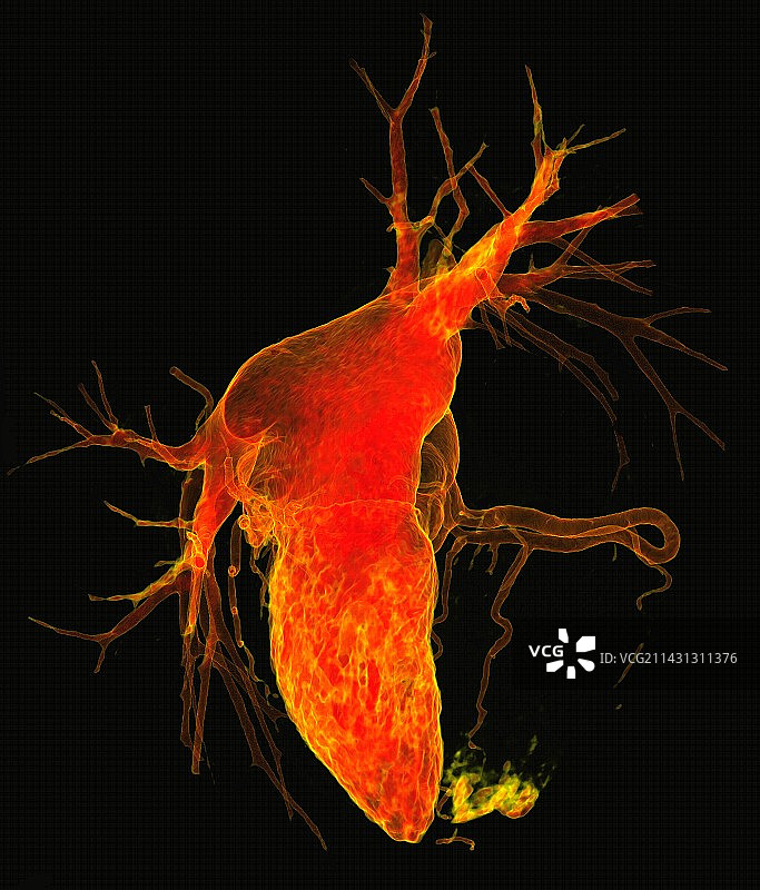 心肌梗死，三维CT血管造影图片素材