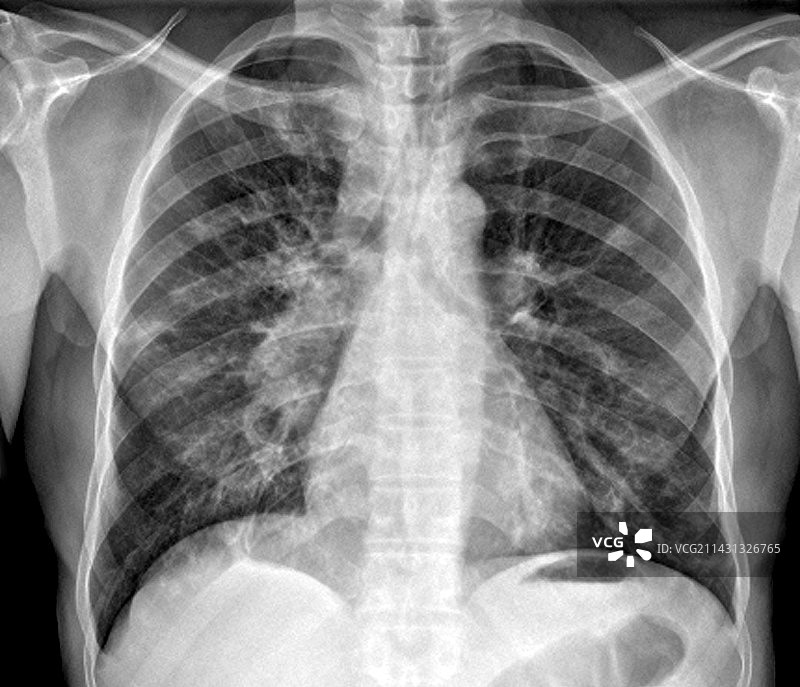 肺结核、肺炎、x光检查图片素材