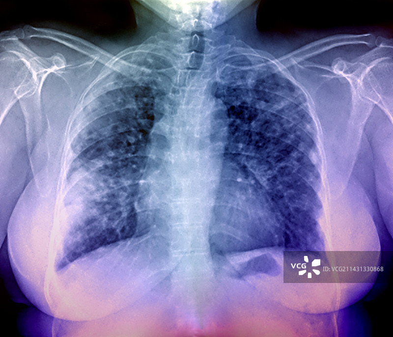 肺部疾病，x光检查图片素材