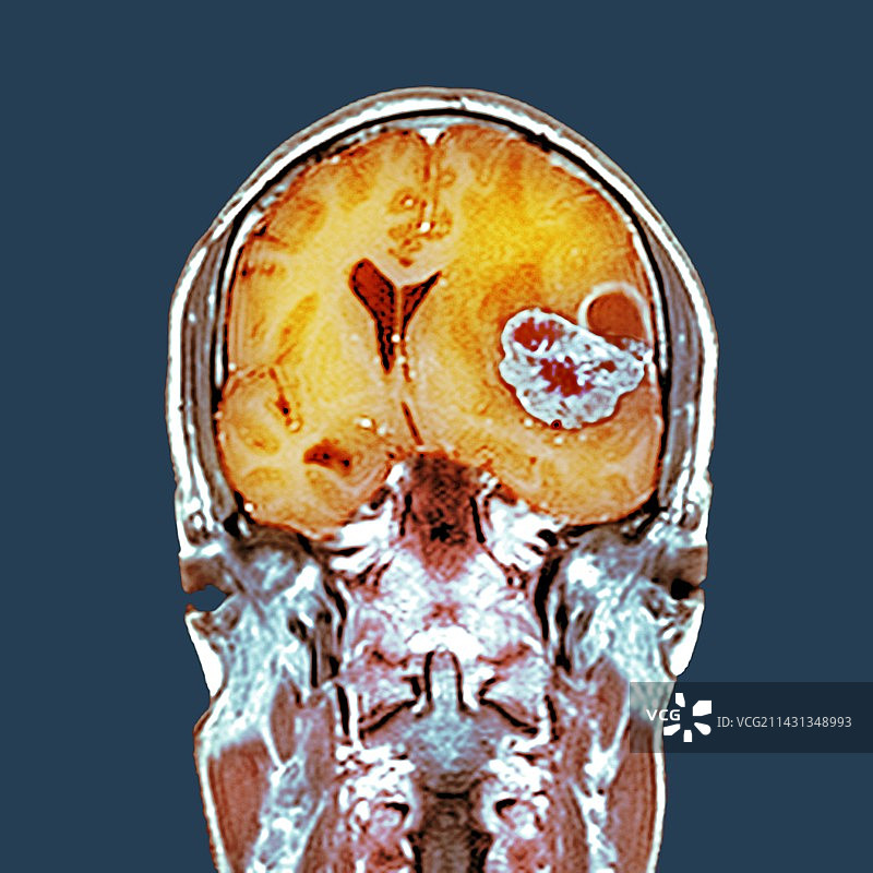 脑癌，核磁共振扫描图片素材