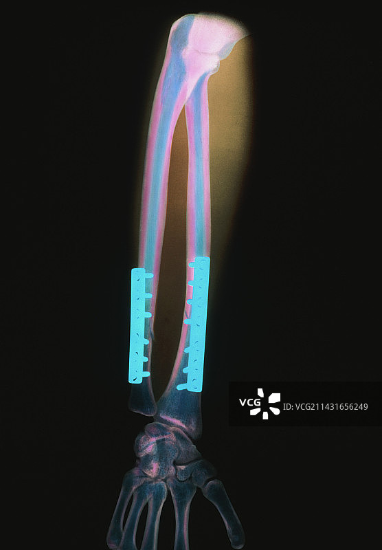 臂骨折用钢针固定的彩色x光片图片素材