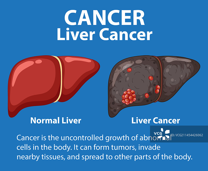 比较健康和癌变肝细胞的生长图片素材