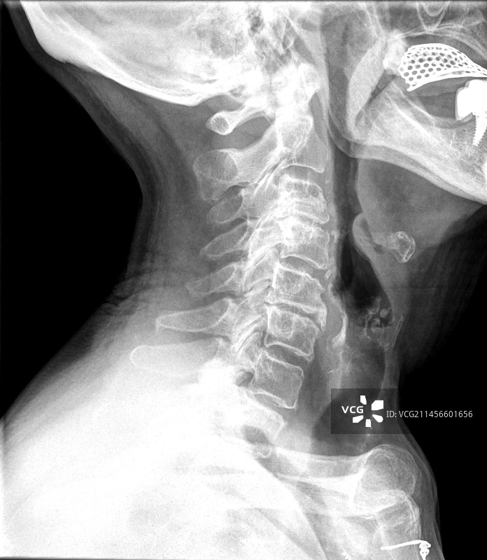 颈椎x光片图片素材