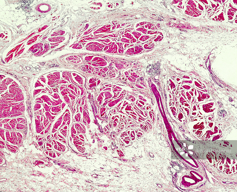 膀胱移行细胞癌，光镜图片素材