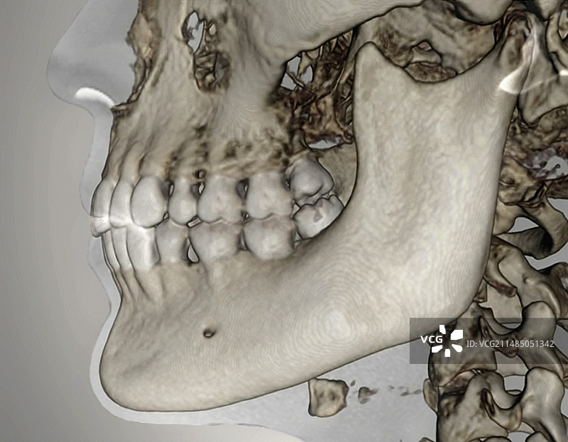 人的下颚，锥形束CT扫描图片素材