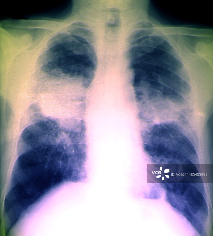 肺部矽肺病，x光片图片素材