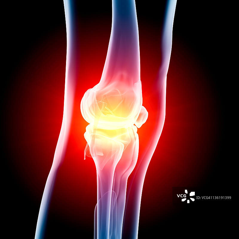 膝关节疼痛x光片图片素材