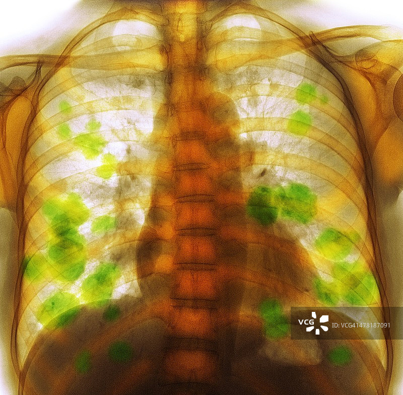继发性肺癌，x线图片素材