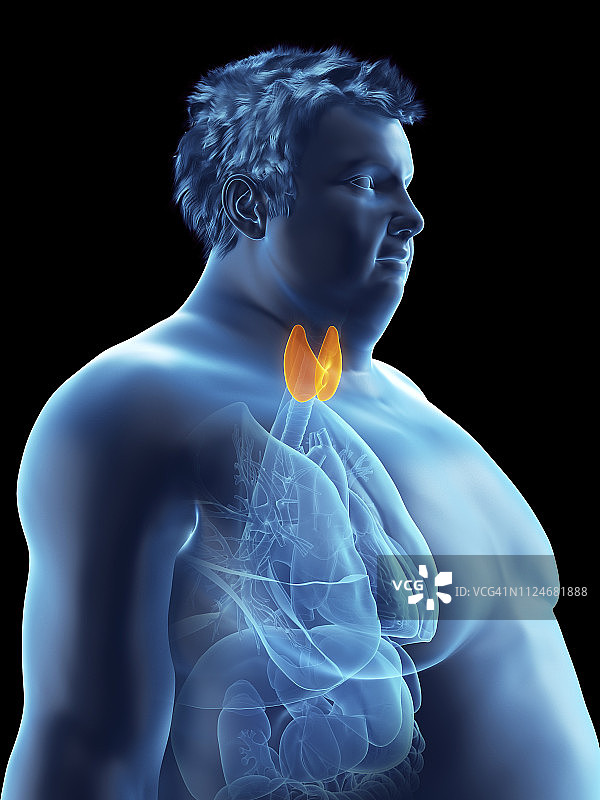 图示:一个肥胖男子的甲状腺图片素材