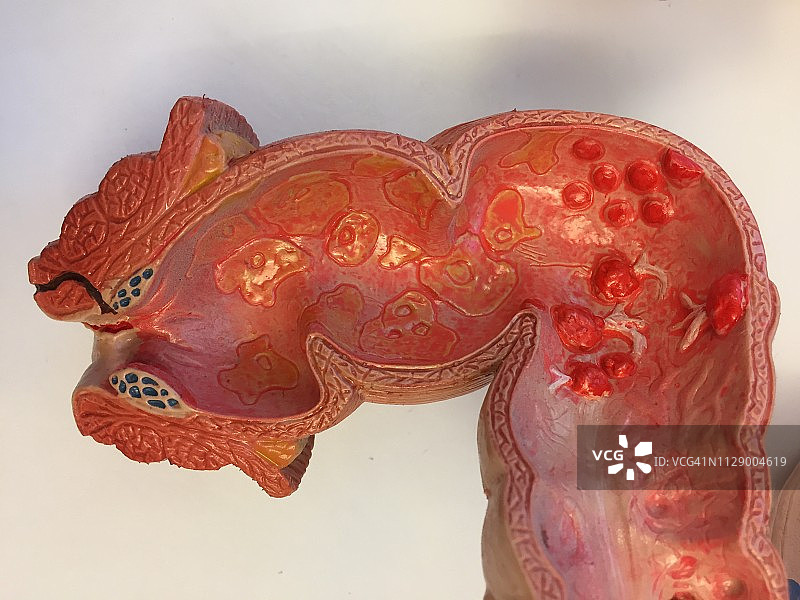 古老的人体肠道解剖模型。结肠癌图片素材