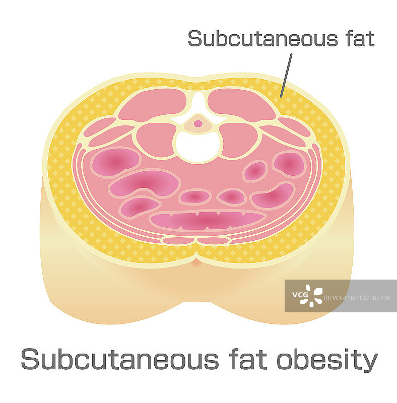 肥胖症的例子。腹部切面(皮下脂肪)。图片素材