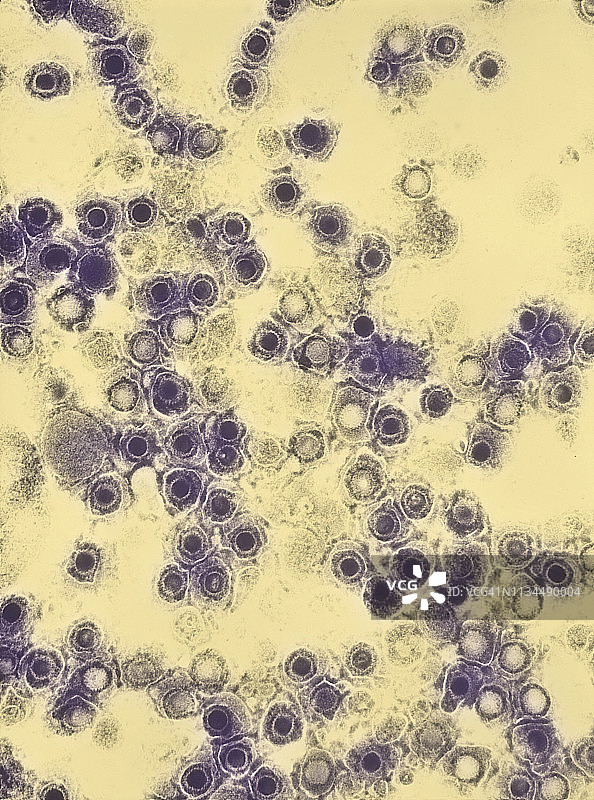 透射电镜显示单纯疱疹病毒粒子图片素材