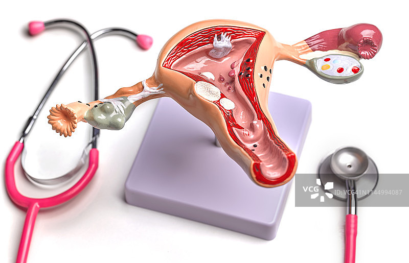 子宫和卵巢解剖模型显示常见的病理图片素材
