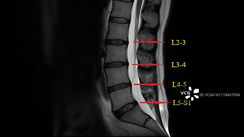 腰椎MRI(磁共振)下背部疼痛成像图片素材