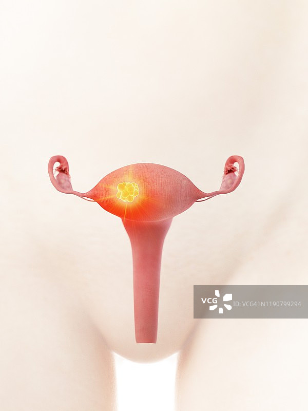 子宫癌，概念说明图片素材