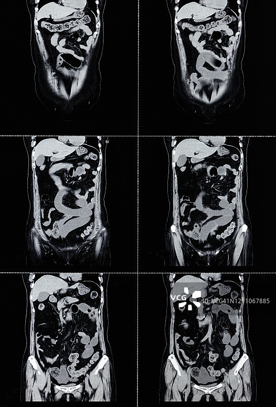 MRI扫描人体腹部正面断层扫描图片素材
