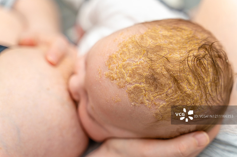 强摇篮帽脂溢性皮炎在婴儿头部头皮哺乳特写图片素材