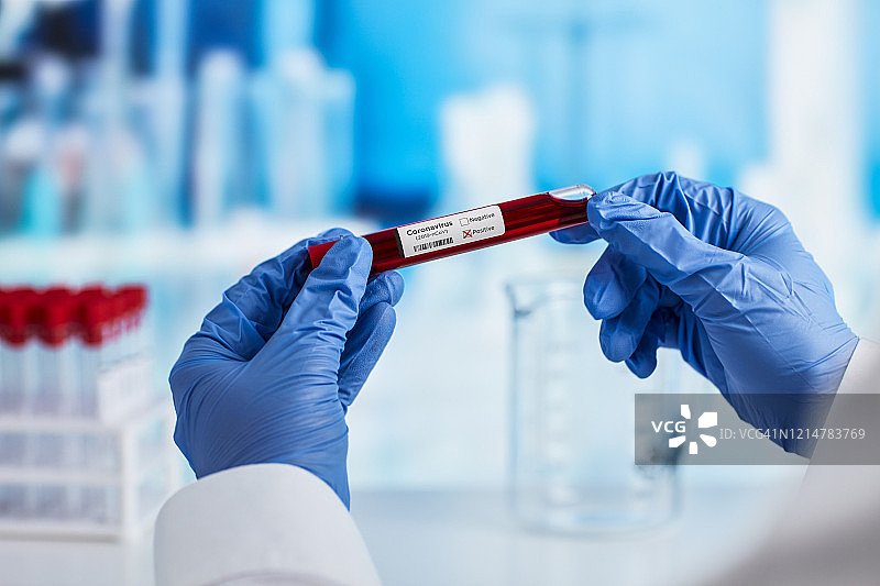 冠状病毒血液检测在医院实验室库存照片图片素材