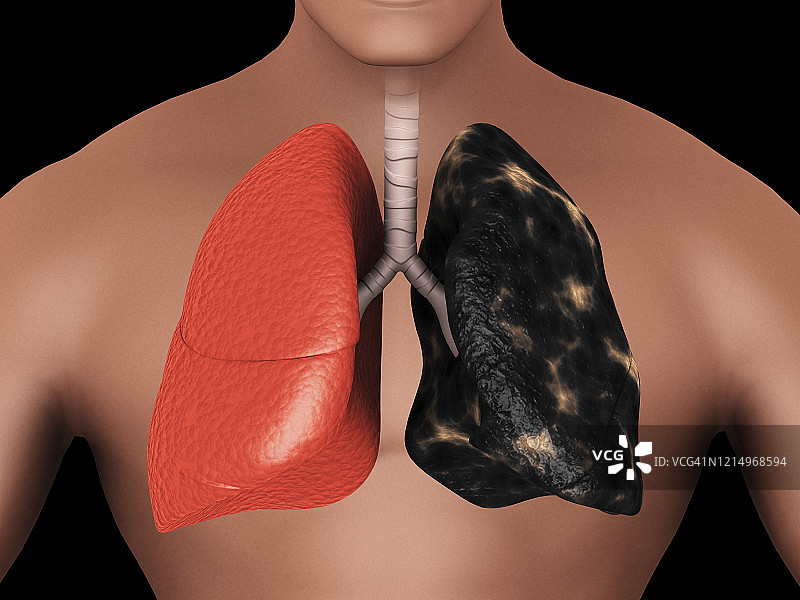 健康肺与吸烟者肺的比较。图片素材