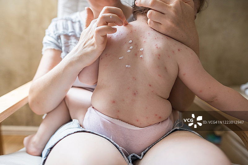 母亲给女儿降温，使她患上水痘带状疱疹图片素材