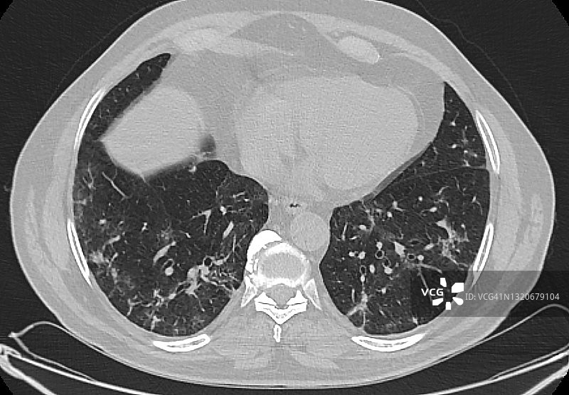 新型冠状病毒肺炎胸部CT扫描，轴向视图图片素材