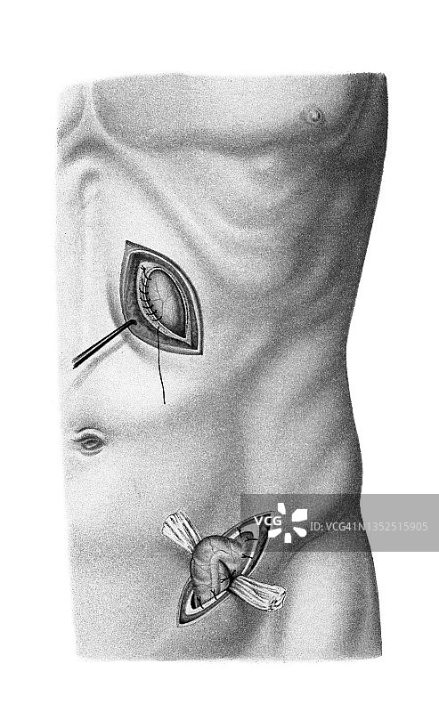 外科手术的旧彩色印刷插图，髂动脉，肠上的瘘管图片素材