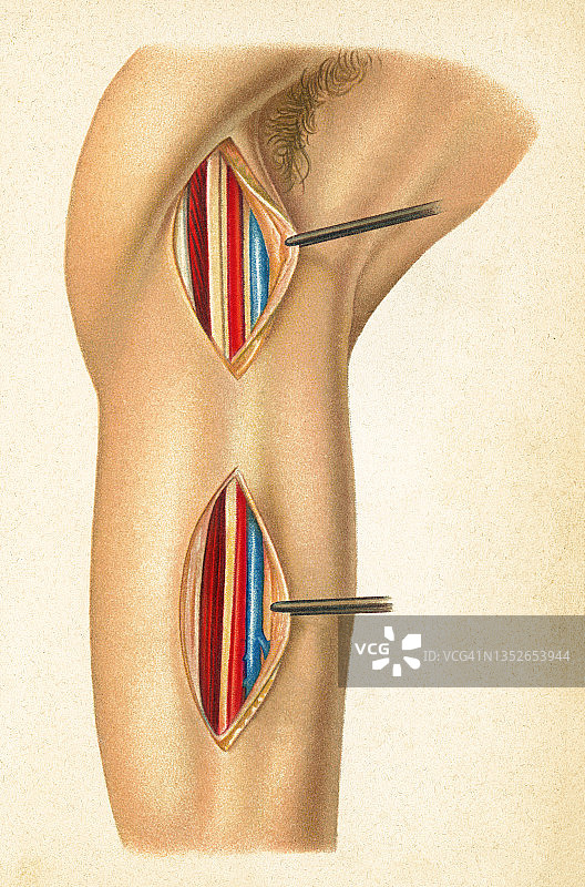 旧的彩色印刷插图的外科手术，暴露肱动脉和腋窝动脉图片素材