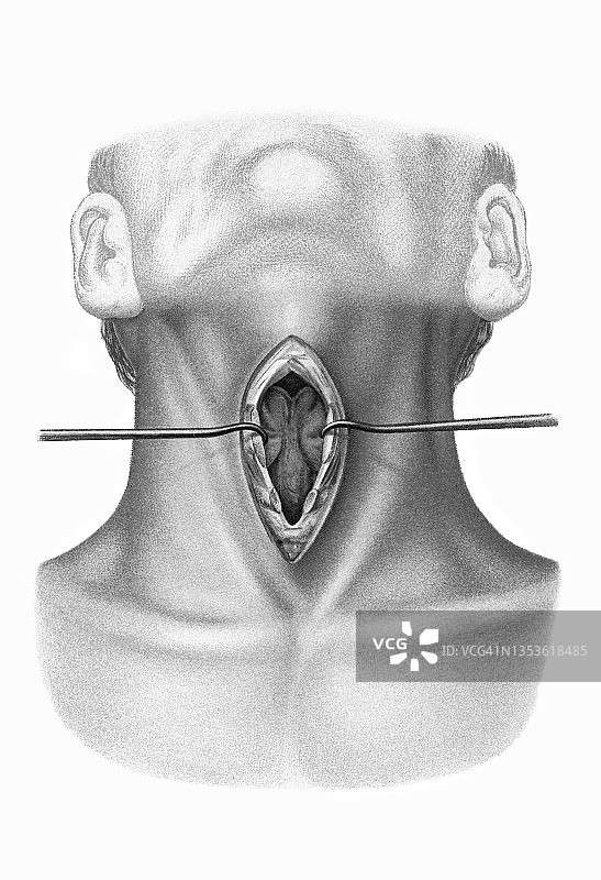 外科手术的旧彩色印刷插图，外科喉头开口(喉裂)图片素材
