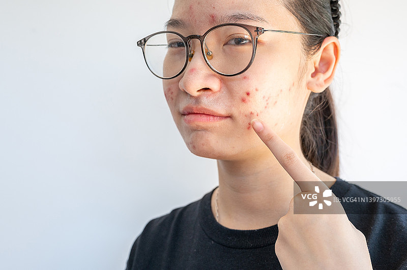 不开心的亚洲女人指着她脸上的痤疮。图片素材