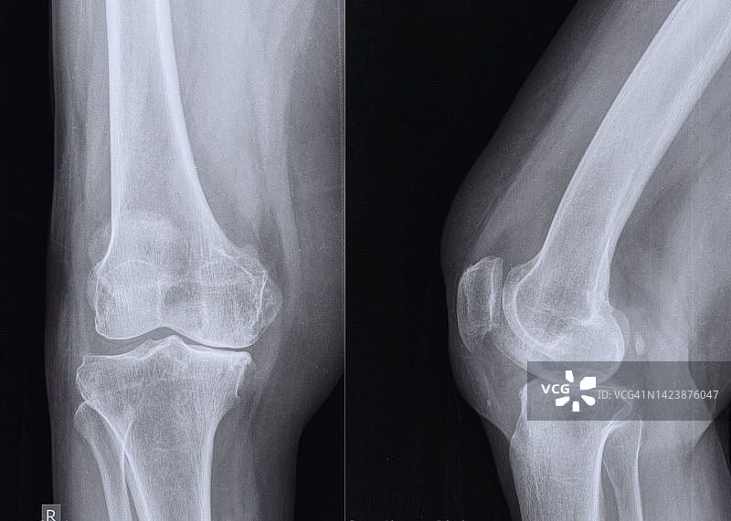 膝盖骨关节炎，x光扫描图片素材