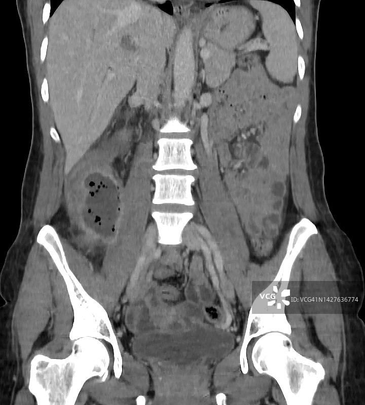 腹部疼痛病人的CT扫描显示阑尾脓肿图片素材
