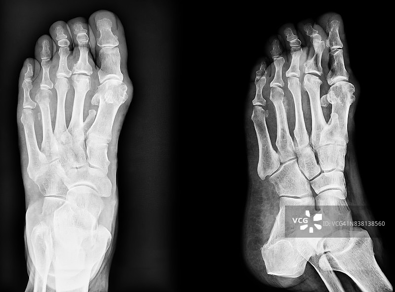 经典x射线脚的特写图像。黑色和白色。图片素材