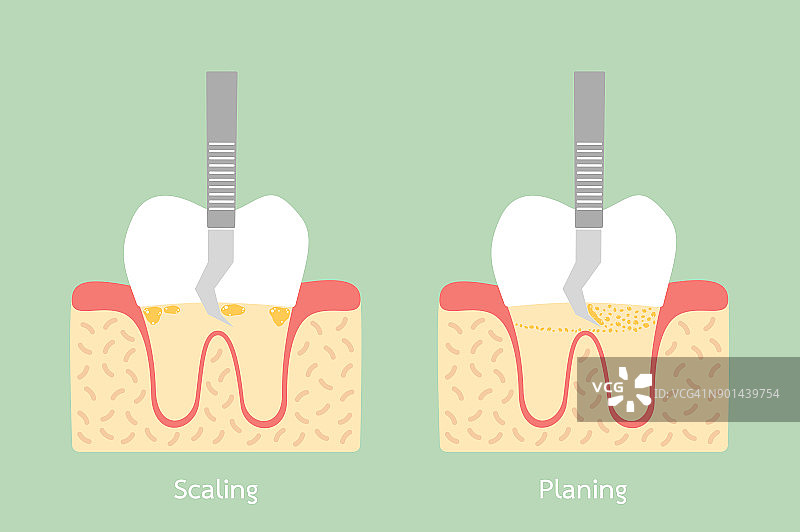 牙齿洁牙——去除牙菌斑，解剖结构包括骨头和牙龈图片素材