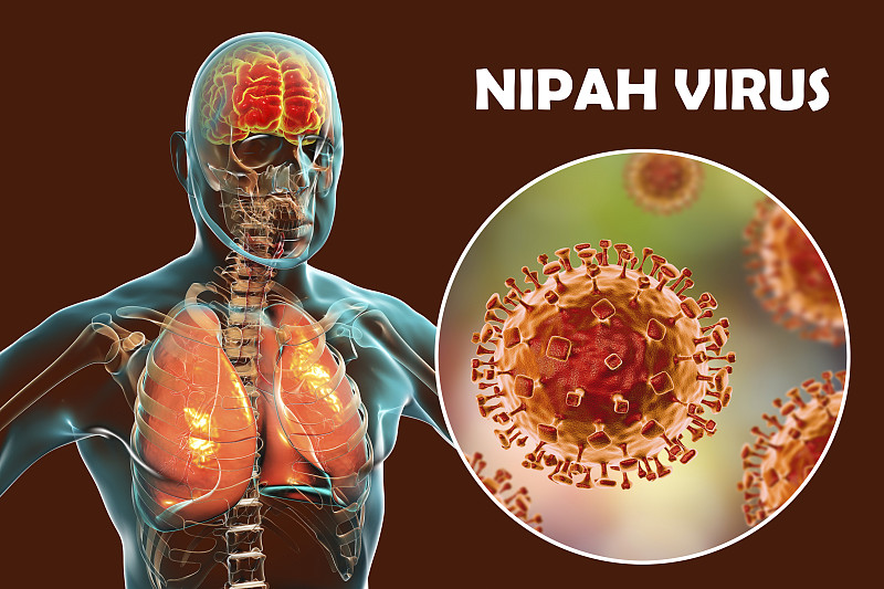 尼帕病毒引起的脑炎，说明图片素材