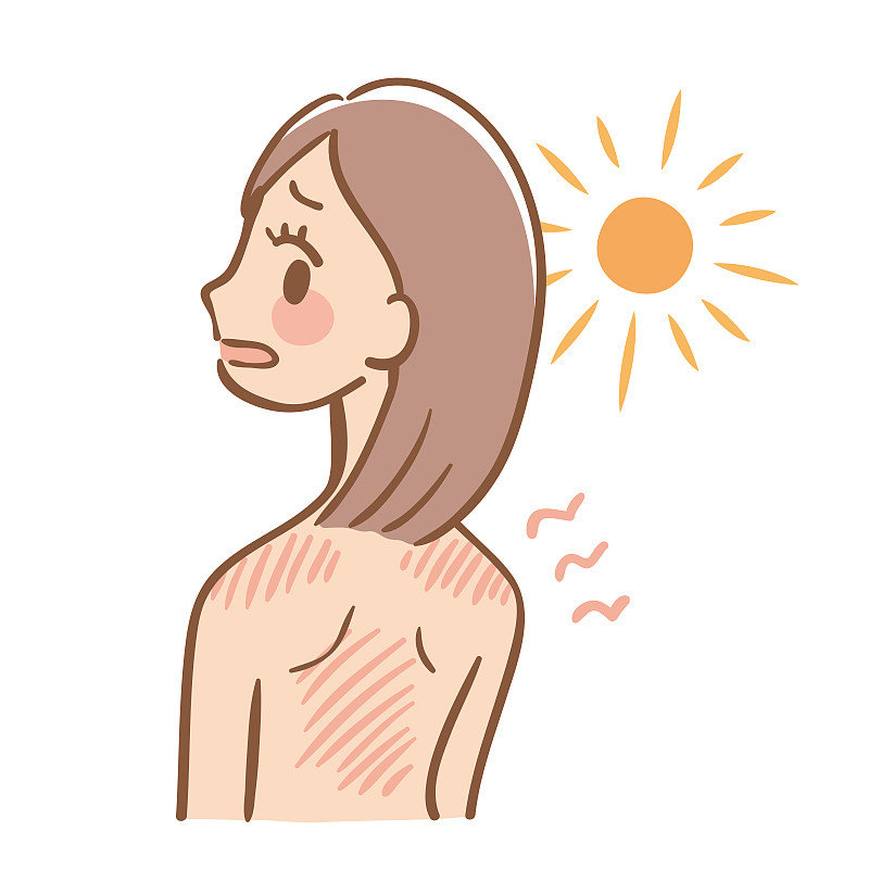 A woman who is sunburned and has a red skin图片素材