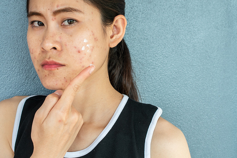 短镜头的女人半脸痤疮炎症(丘疹和脓疱)在她的脸上，她在脸上涂抹痤疮霜治疗。图片下载