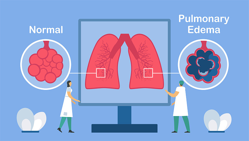 肺水肿表现为好肺泡和坏肺泡。又称肺充血、肺水、肺充血。ฺ身体努力获得足够的氧气，直到呼吸急促。图片下载