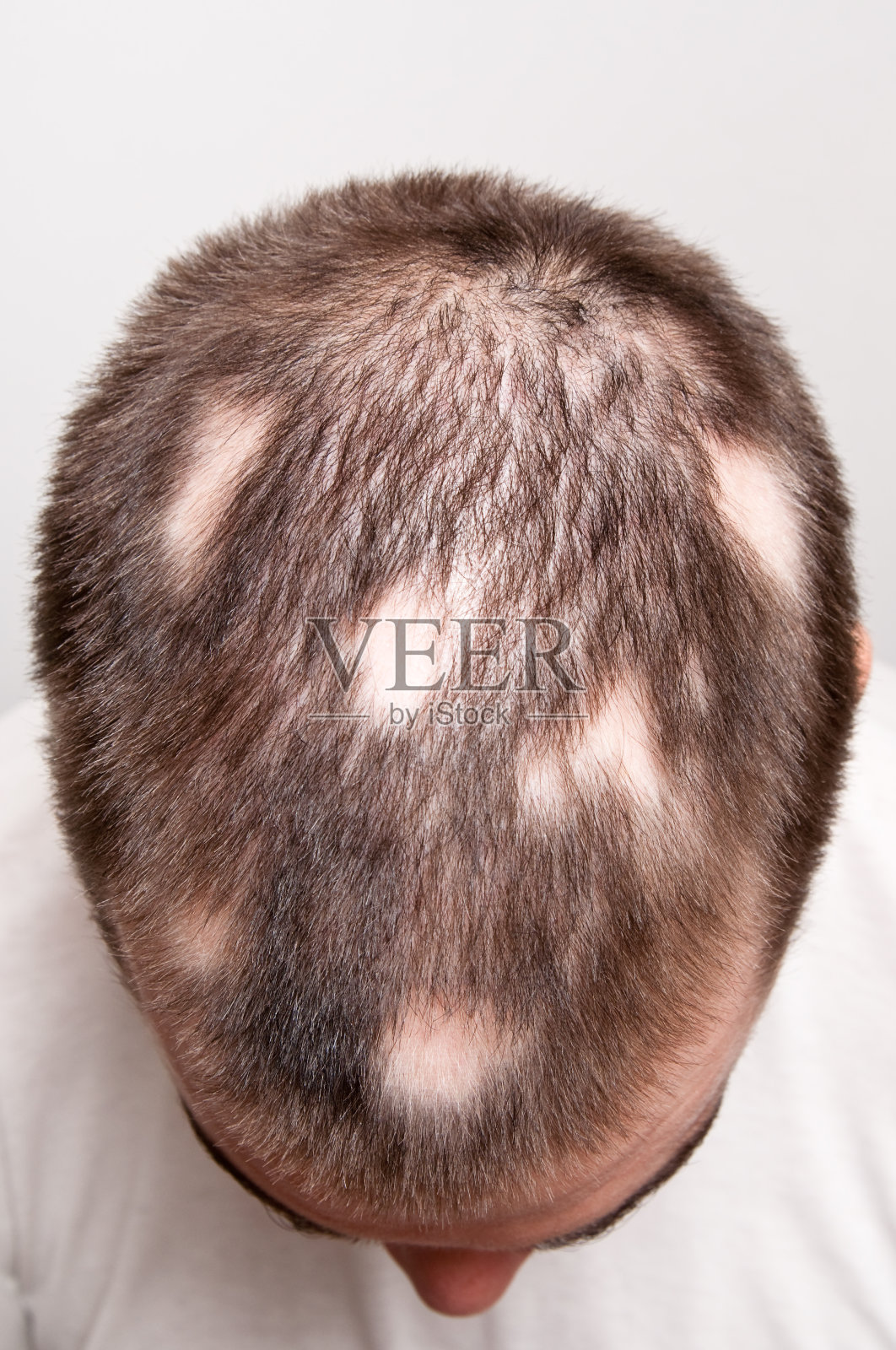 男人遭受脱发引起的秃斑照片摄影图片