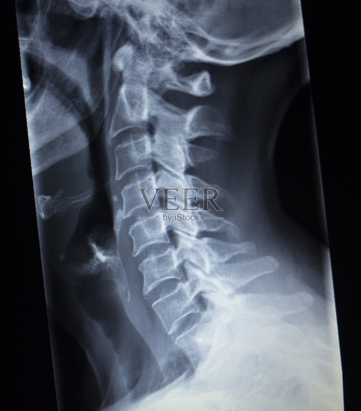 颈部外伤的x线扫描照片摄影图片