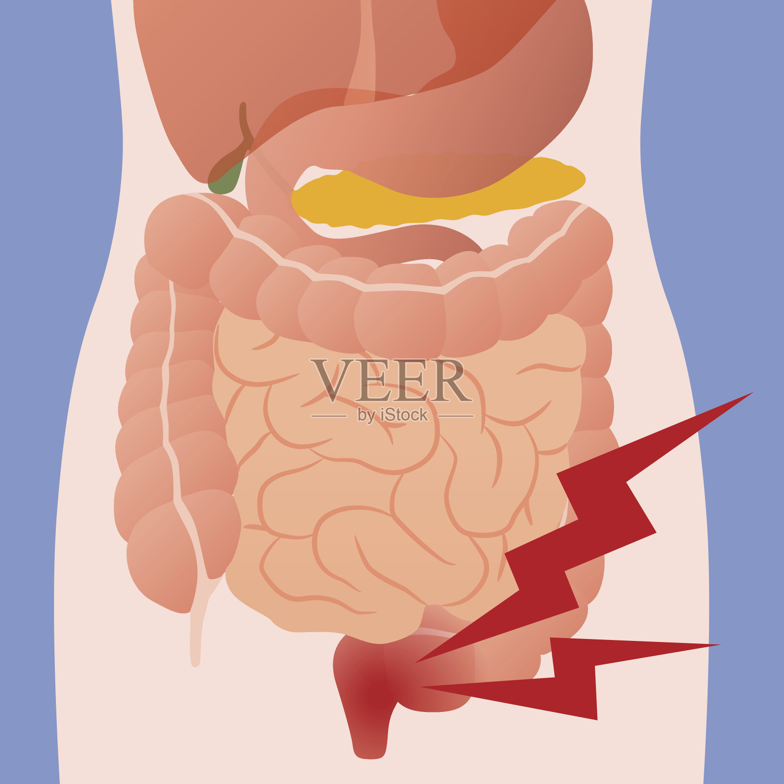 肠炎肠和人体消化器官的炎症插画图片素材