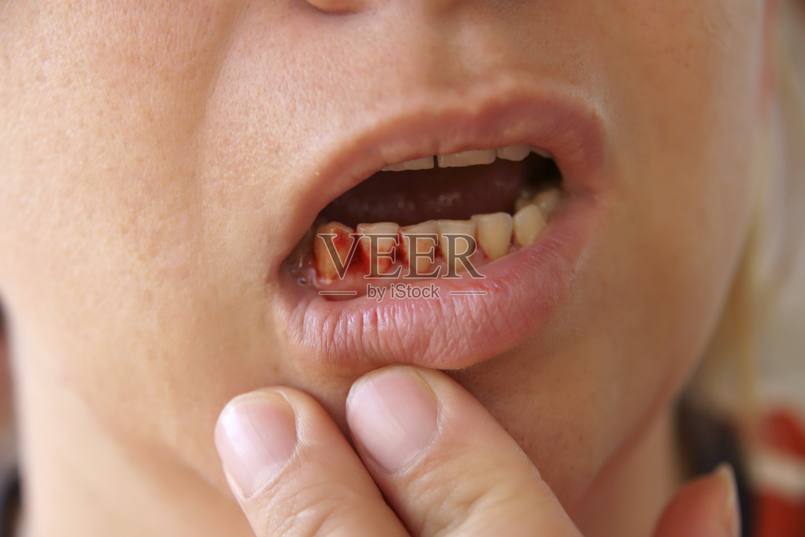 人按住嘴唇，露出流血的牙龈照片摄影图片