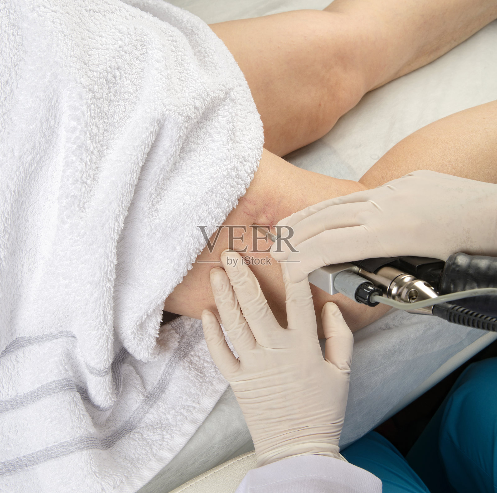 医生治疗病人的腿部静脉曲张照片摄影图片